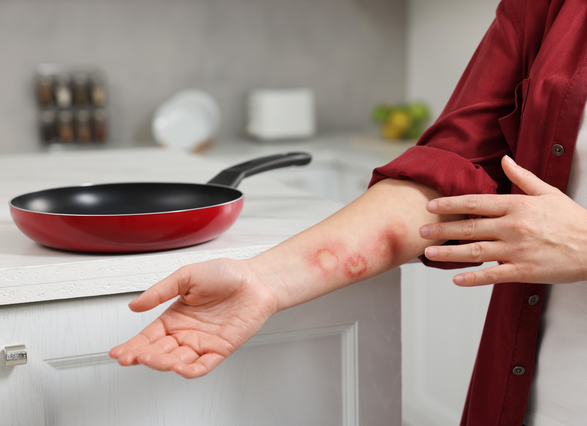 Brazo con quemaduras