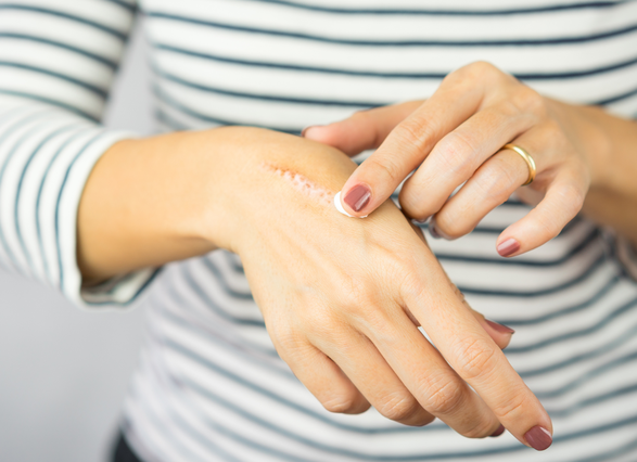 Dedo tocando cicatriz en la mano